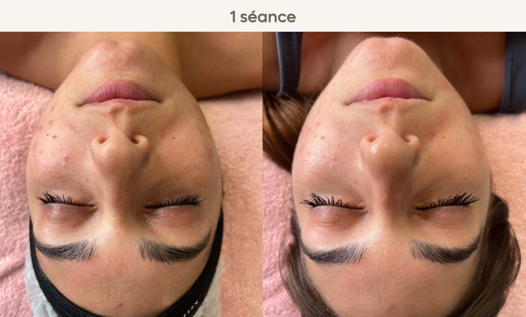 Avant / après carboxythérapie visage : rides lissées et peau raffermie