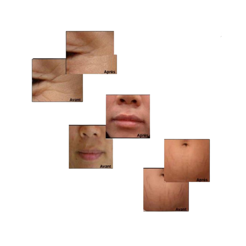 Masque de carboxythérapie, masque carboxy, masque carboxy CO2, Masque CO2,
Soin visage innovant
Oxygénation cellulaire
Microcirculation
Peaux acnéiques
Réduction des boutons
Pores resserrés
Teint uniforme
Régénération cutanée
Taches pigmentaires
Effet Bohr
Peau éclatante
Anti-âge
Hydratation profonde
Soin dermo-cosmétique
Masque de Carboxythérapie CO₂, soin visage innovant. Stimule l’oxygénation cellulaire, améliore la microcirculation et réduit les imperfections cutanées. Idéal pour réduire les boutons