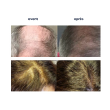 Sérum otesaly, soin anti-chute cheveux, mesotherapy, microneedling